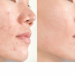 Acne Scars And Pores. Black Spots, Wrinkles And Skin Problems